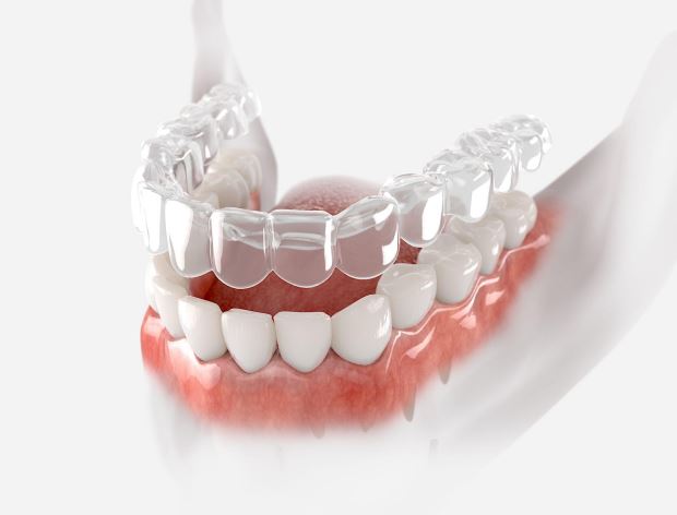 Clear aligners treatment at best dental clinic in Iyyappanthangal Chennai